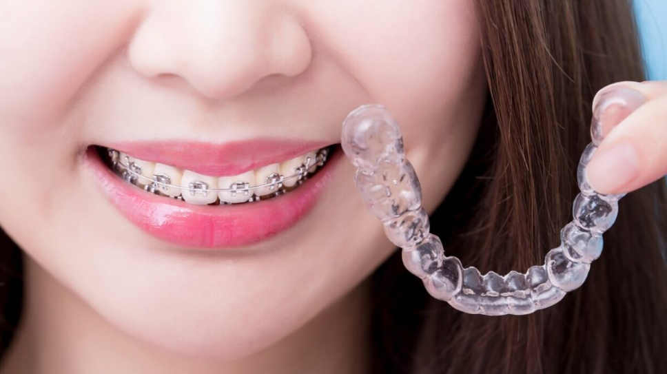 A beautiful girl smiling and showing the Invisalign clear aligners