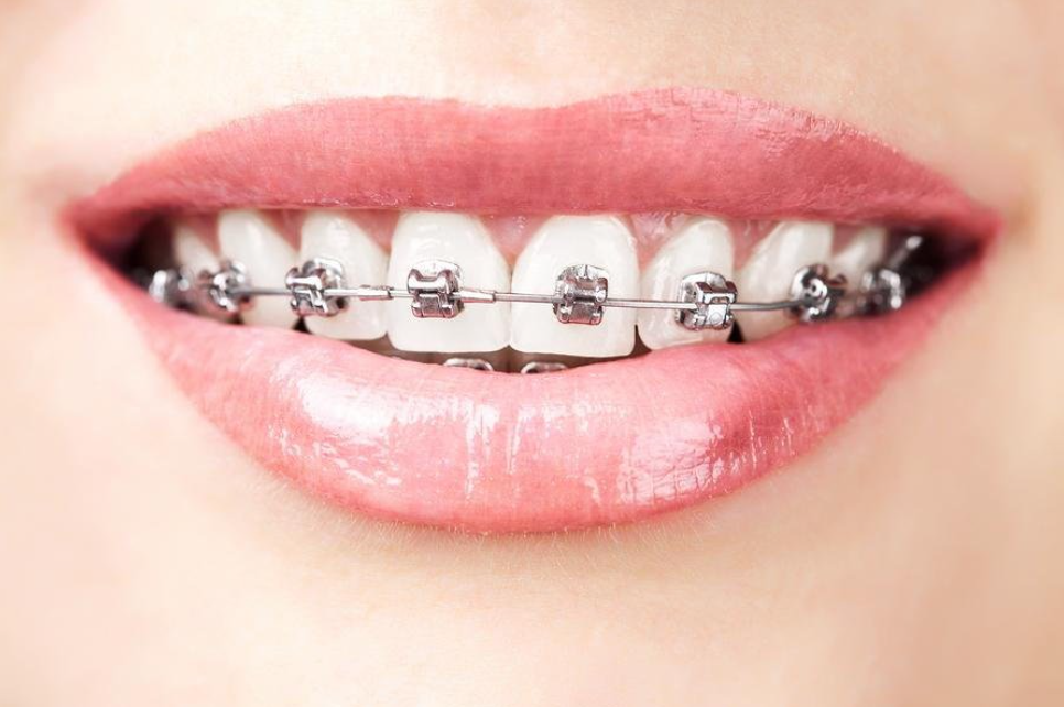 A beautiful smile with metallic braces
