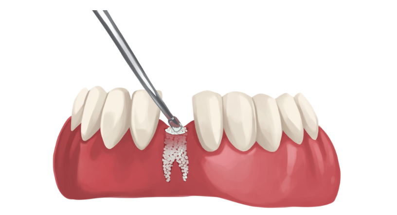 A visual demonstration of bone grafting