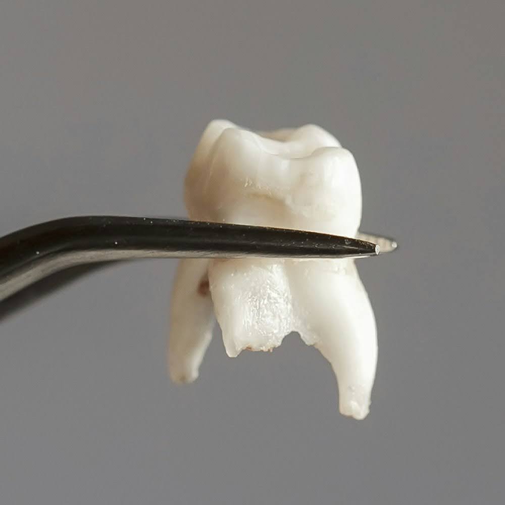 A picture of a fractured tooth removal with the lowest tooth extraction cost in the area