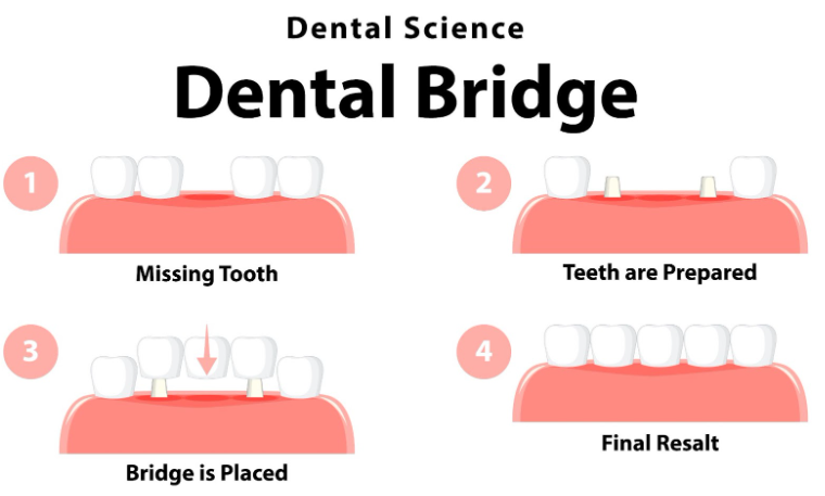 An image showing dental bridge process