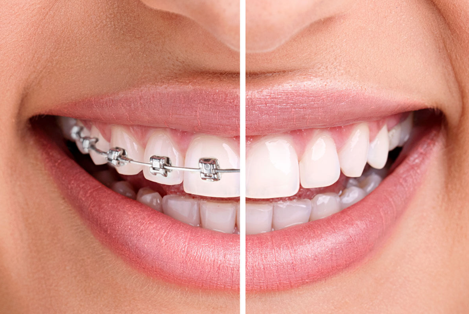 Clear braces vs traditional metallic braces