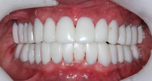    A Set of Teeth Implants After a Full Mouth Dental Implants Cost
  Consultation