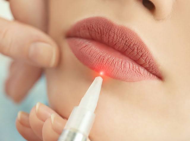 Laser lip treatment from our dentist for plump lips