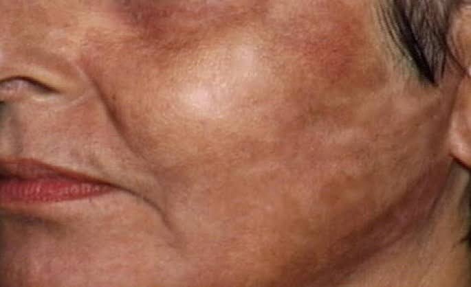 Red and white shades on an old lady's skin looking into laser treatment for wrinkles