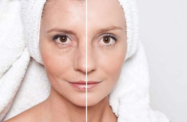 Skin of a lady before and after the laser skin resurfacing