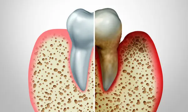  A model showing the difference between healthy and decaying teeth.