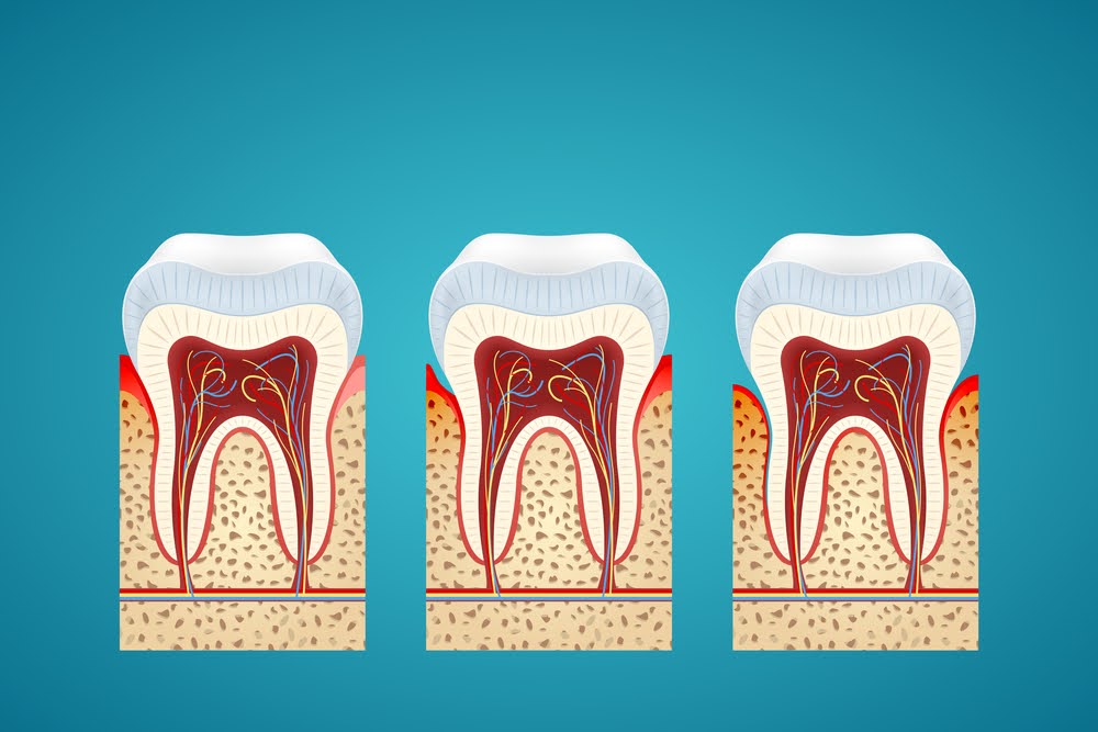  A visual representation of various gum disease stages.