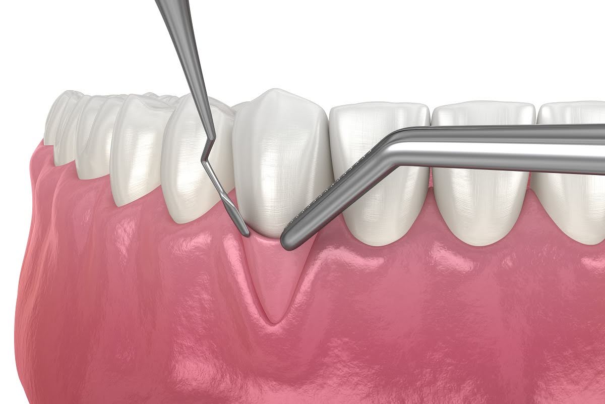  A visual representation of invasive receding gum treatment.