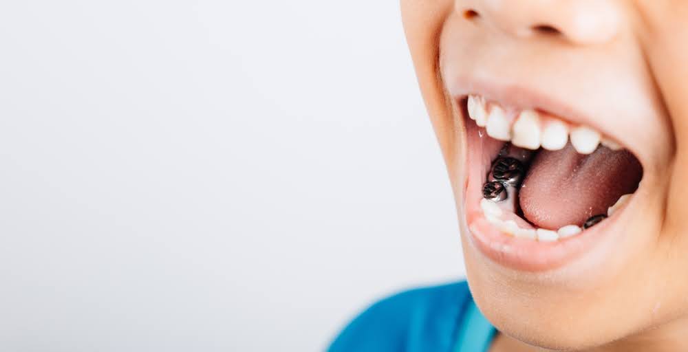  Close-up of a child's open mouth with pediatric stainless steel crowns on their molars
