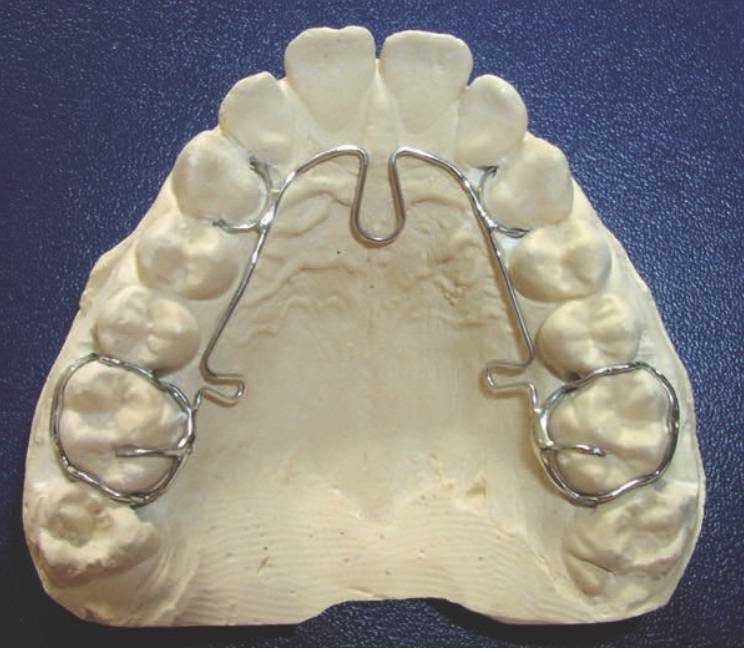  An advanced lightwire functional device placed on a larger model of teeth